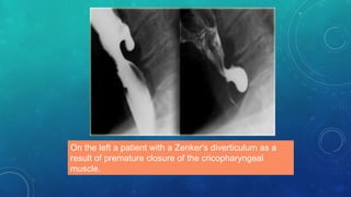On the left a patient with a Zenker's diverticulum as a
result of premature closure of the cricopharyngeal
muscle.
 