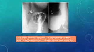 LEFT: Small diverticulum (arrow) in asymptomatic patient
RIGHT: Large diverticulum (arrow) in patient with aspiration
 