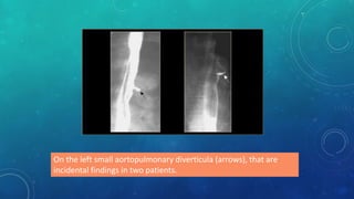 On the left small aortopulmonary diverticula (arrows), that are
incidental findings in two patients.
 