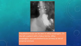 Pseudodiverticula can be seen in reflux esophagitis. On
the left a patient with a hiatus hernia, reflux
esophagitis, and pseudodiverticula (arrows) at site of
proximal stricture
 