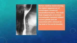 Barium swallow demonstrating
the typical appearances of
oesophageal intramural
pseudodiverticulosis. The small
flask-shaped pits of contrast
(arrowheads) represent dilated
mucous glands and are
associated with a stricture at
the level of the aortic knuckle.
 