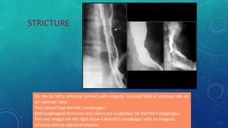 On the far left a stricture (arrow) with irregular mucosal folds at stricture site on
air-contrast view.
This patient had Barrett's esophagus.
Mid esophageal strictures and ulcers are suspicious for Barrett's esophagus.
The two images on the right show a Barrett's esophagus with an irregular
stricture due to adenocarcinoma.
STRICTURE
 