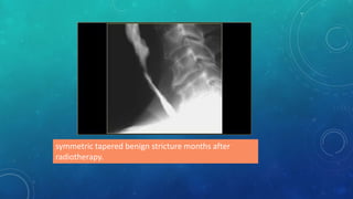 symmetric tapered benign stricture months after
radiotherapy.
 