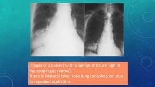 images of a patient with a benign stricture high in
the esophagus (arrow).
There is bilateral lower lobe lung consolidation due
to repeated aspiration.
 