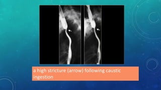 a high stricture (arrow) following caustic
ingestion
 