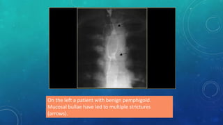 On the left a patient with benign pemphigoid.
Mucosal bullae have led to multiple strictures
(arrows).
 