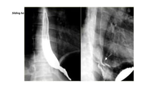 Sliding hernia
 