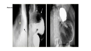 Para-esophageal hernia
 