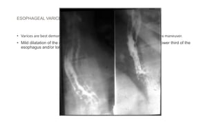 ESOPHAGEAL VARICES
• Varices are best demonstrated in mucosal relief study after using Buscopan/ valsalva maneuver.
• Mild dilatation of the esophagus with multiple persistent filling defects in the lower third of the
esophagus and/or longitudinal furrows.
 