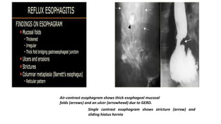 Air-contrast esophagram shows thick esophageal mucosal
folds (arrows) and an ulcer (arrowhead) due to GERD.
Single contrast esophagram shows stricture (arrow) and
sliding hiatus hernia
 