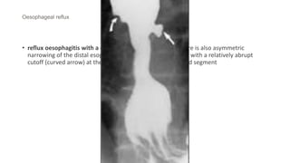 Oesophageal reflux
• reflux oesophagitis with a deep ulcer (straight arrow). There is also asymmetric
narrowing of the distal esophagus with the distal esophagus with a relatively abrupt
cutoff (curved arrow) at the proximal border of the narrowed segment
 