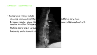 CANDIDA ESOPHAGITIS
• Radiographic findings include
1. Abnormql esophageal motility ( dilated, atonic esophagus ) is often an early stage
2. Irregular, nodular, plaque-like mucosal pattern ( arrow), irregular folds(arrowhead) with
marginal serrations ( shaggy appearance )
3. Multiple ulcerations of various sizes
4. Frequently involve the entire thoracic esophagus
 