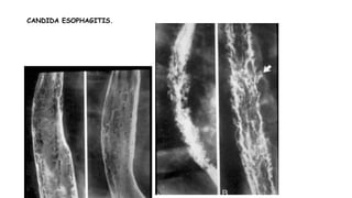 CANDIDA ESOPHAGITIS.
 