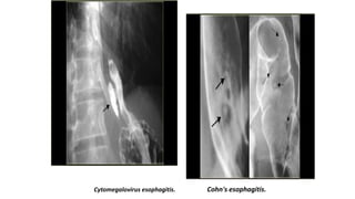 Cytomegalovirus esophagitis. Cohn's esophagitis.
 