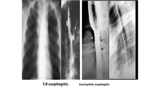 T.B esophagitis. Eosinophilic esophagitis
 