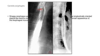 Candida esophagitis
• Shaggy esophagus associated with Candida infection , image "A" depicts the longitudinally oriented
plaque-like lesions visible in Candida esophagitis , image "B" depicts the granular appearance of
the esophageal mucosa secondary to edema and inflammation
 