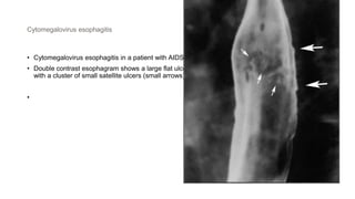 Cytomegalovirus esophagitis
• Cytomegalovirus esophagitis in a patient with AIDS
• Double contrast esophagram shows a large flat ulcer in profile (large arrows) in the midesophagus
with a cluster of small satellite ulcers (small arrows)
•
 