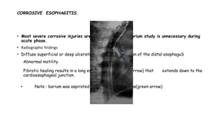 CORROSIVE ESOPHAGITIS.
• Most severe corrosive injuries are caused by alkalis Barium study is unnecessary during
acute phase.
• Radiographic findings
• Diffuse superficial or deep ulceration involving long portion of the distal esophaguS
1. Abnormal motility
2. Fibrotic healing results in a long esophageal stricture ( arrow) that extends down to the
cardioesophageal junction.
• Note : barium was aspirated into left main bronchus(green arrow)
 