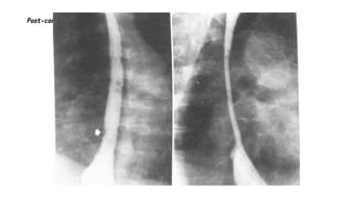 Post-corrosive stricture.
 