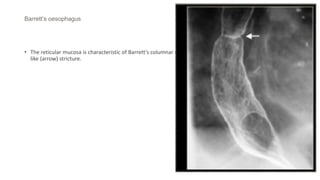 Barrett’s oesophagus
• The reticular mucosa is characteristic of Barrett's columnar metaplasia, especially with the associated web
like (arrow) stricture.
 