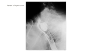 Zenker’s Diverticulum
 