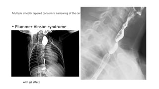 Multiple smooth tapered concentric narrowing of the cervical esophagus in keeping with esophageal webs.
• Plummer-Vinson syndrome
with jet effect
 