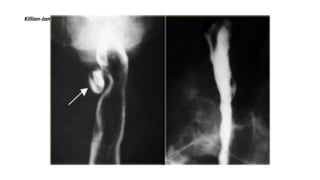 Killian-Jamieson diverticulum: AP and lateral view
 