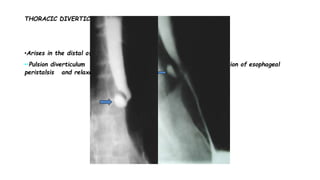 THORACIC DIVERTICULUM
•Arises in the distal of the esophagus, just above diaphragm
••Pulsion diverticulum (arrow) that probably related to incoordination of esophageal
peristalsis and relaxation of the lower esophageal sphincter
 