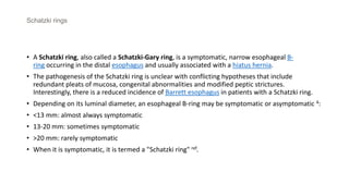Schatzki rings
• A Schatzki ring, also called a Schatzki-Gary ring, is a symptomatic, narrow esophageal B-
ring occurring in the distal esophagus and usually associated with a hiatus hernia.
• The pathogenesis of the Schatzki ring is unclear with conflicting hypotheses that include
redundant pleats of mucosa, congenital abnormalities and modified peptic strictures.
Interestingly, there is a reduced incidence of Barrett esophagus in patients with a Schatzki ring.
• Depending on its luminal diameter, an esophageal B-ring may be symptomatic or asymptomatic 4:
• <13 mm: almost always symptomatic
• 13-20 mm: sometimes symptomatic
• >20 mm: rarely symptomatic
• When it is symptomatic, it is termed a "Schatzki ring" ref.
 