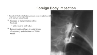 • To detect the level of obstruction in case of radiolucent foreign body in esophagus,marsh mellow coated
with barium is swallowed
• Passage of marsh mellow will be
hindered
• at the level of obstruction
• Barium swallow shows irregular areas
of narrowing and dilatation ----“Shish
kebab”
Foreign Body Impaction
 