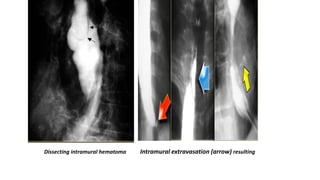 Dissecting intramural hematoma Intramural extravasation (arrow) resulting
 