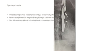 Dysphagia lusoria
• The oesophagus may be compressed by a congenitally aberrant right subclavian artery.
• If this is symptomatic a diagnosis of dysphagia lusoria is made
• Here it is seen as oblique tubular extrinsic compression in upper oesophagus.
 