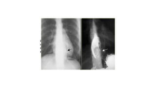 Leiomyomas
Leiomyomas are the most common benign esophageal
neoplasm and are often large yet nonobstructive.
Gastrointestinal stromal tumors (GIST) are least common in
the esophagus.
 
