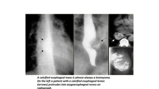 A calcified esophageal mass is almost always a leiomyoma.
On the left a patient with a calcified esophageal lesion
(arrows) protrudes into azygoesophageal recess on
radiograph.
 