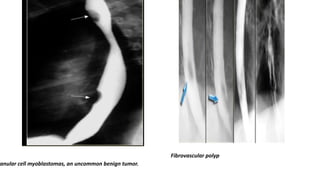 ranular cell myoblastomas, an uncommon benign tumor.
Fibrovascular polyp
 