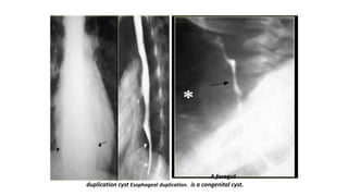 A foregut
duplication cyst Esophageal duplication. is a congenital cyst.
 
