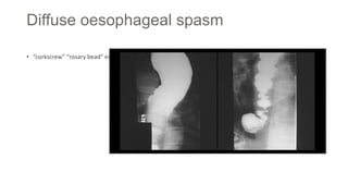 Diffuse oesophageal spasm
• “corkscrew” “rosary bead" esophagus The esophageal muscle is hypertrophied, but histologically normal
 