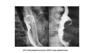 LEFT: Small polypoid carcinoma. RIGHT: Large polypoid lesion.
 