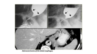 Adenocarcinoma of the distal esophagus.
 