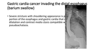 Gastric cardia cancer invading the distal esophagus
(barium swallow)
• Severe stricture with shouldering appearance is present at the distal
portion of the esophagus and gastric cardia that causes pre-stricture
dilatation and contrast media stasis compatible with esophageal
pseudoachalasia.
 