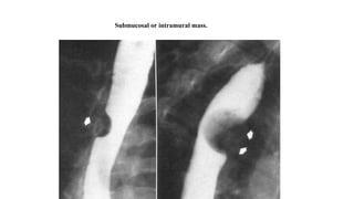 Submucosal or intramural mass.
 