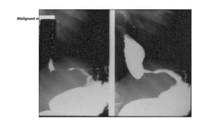 Malignant mass at the distal esophagus.
 