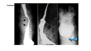 Esophageal obstruction due to metastatic mediastinal lymph nodes.
 