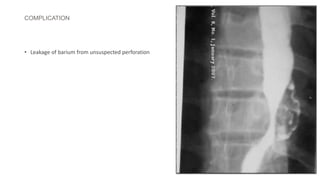 COMPLICATION
• Leakage of barium from unsuspected perforation
 