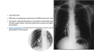 • ASPIRATION
• Difficulty in swallowing, long history of GERD and recent unintentional loss of weight.
• During the rapid-drinking phase, the patient accidentally aspirated a small amount of barium (without any
elicited cough reflex). Contrast outlines the trachea and right main bronchus and smaller amount reached
bronchioles.
• Barium aspiration is an indication to terminate a study, and we sent the patient to be under close
observation in the hospital for 24 hours.
 