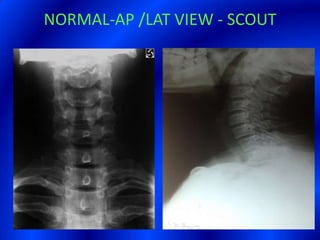 NORMAL-AP /LAT VIEW - SCOUT