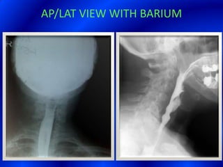 AP/LAT VIEW WITH BARIUM