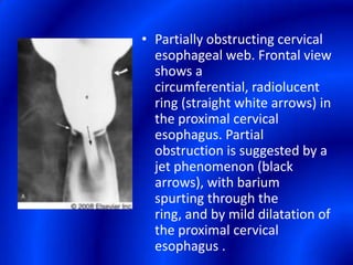Partially obstructing cervical esophageal web. Frontal view shows a circumferential, radiolucent ring (straight white arrows) in the proximal cervical esophagus. Partial obstruction is suggested by a jet phenomenon (black arrows), with barium spurting through the ring, and by mild dilatation of the proximal cervical esophagus .