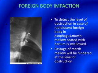 FOREIGN BODY IMPACTION.To detect the level of obstruction in case of radiolucent foreign body in esophagus,marsh mellow coated with barium is swallowed.Passage of marsh mellow will be hindered at the level of obstruction