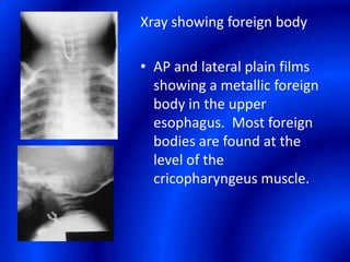Xray showing foreign bodyAP and lateral plain films showing a metallic foreign body in the upper esophagus.  Most foreign bodies are found at the level of the cricopharyngeus muscle.